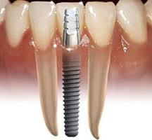 Dental Implants, what are they and can I have them?