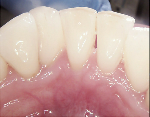 Tooth Staining after it has been removed with treatment