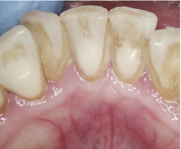 Tooth Staining, what is it and how Should I Remove it?