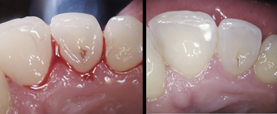 Bleeding gums before and after flossing