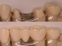 Missing teeth replaces with a fixed bridge