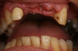 Missing teeth before denture