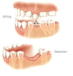 Not replacing missing teeth can cause resorbtion and drifting