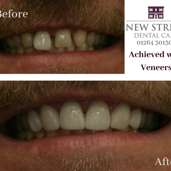 Can Dental Veneers Really Give You A New Smile?