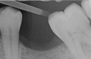 X-ray of drift and resorption cause by missing teeth