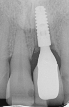 X-ray image of implant replacing a missing tooth
