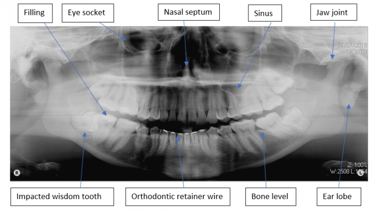 OPG x-ray of whole mouth - New Street Dental Care