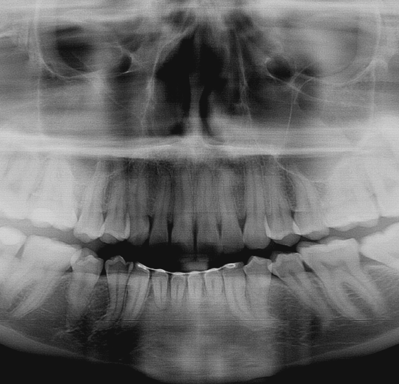 Dental X-Rays, a Peek Inside your Teeth