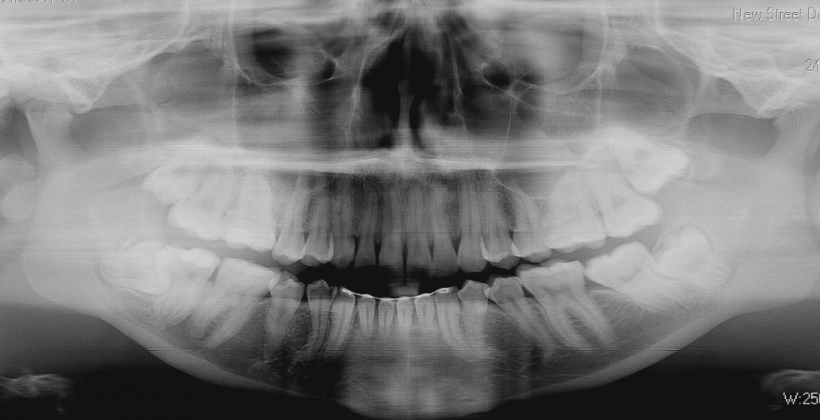 Dental X-Rays, a Peek Inside your Teeth