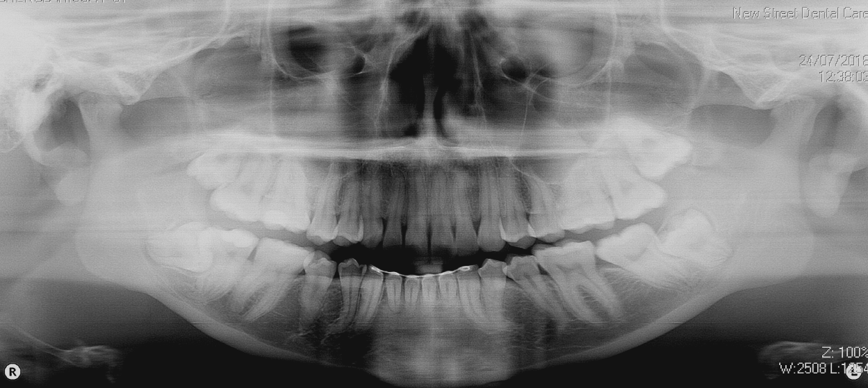 OPG dental x-ray