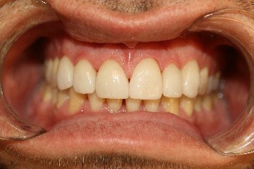 Dental Veneers Placed on the Top Teeth at New Street Dental Care Andover