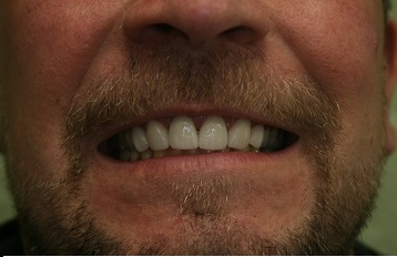 Dental Veneers after treatment at New Street Dental Care