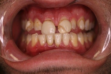 Teeth before Dental Veneers have been placed on the top teeth