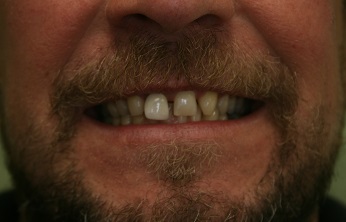 Before treatment of Dental Veneers at New Street Dental Care