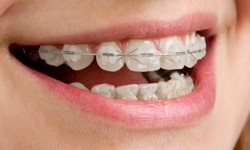 Ceramic Fixed Braces at New Street Dental Care in Andover