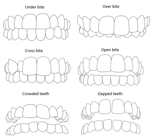 How teeth can be moved using braces at New Street Dental Care in Andover