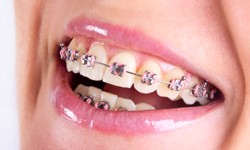 Traditional fixed braces at New Street Dental Care