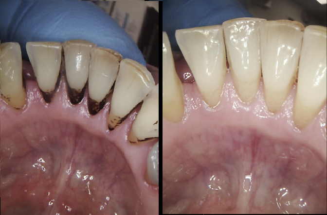 Staining can be removed by the hygienist at New Street Dntal Care with the ariflow polish