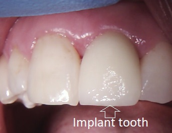 Implant placed at New Street Dental Care in Andover