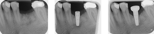 X-rays of implant stages placed at New Street Dental Care Andover
