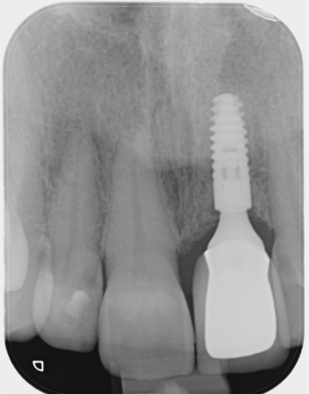 X-ray of a dental implant placed at New Street Dental Care in Andover