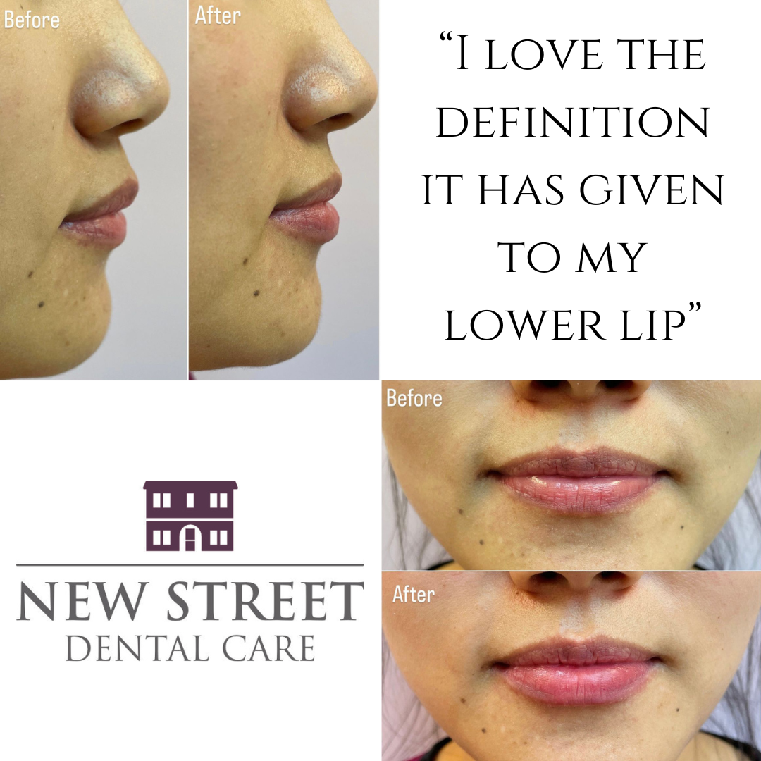 “I love the definition it has given to my lower lip”
